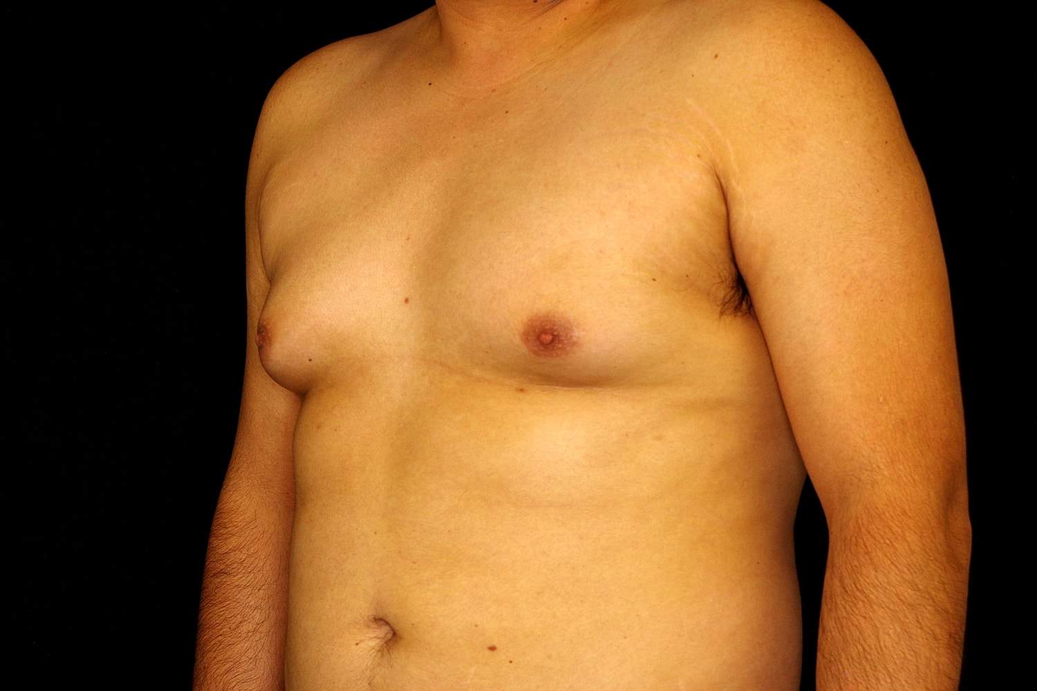 Gynecomastia Before & After