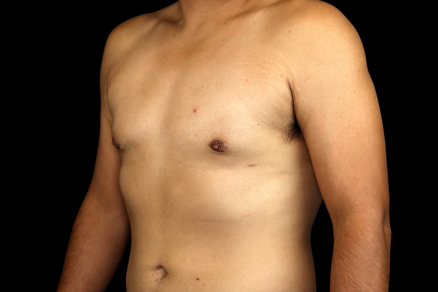 Gynecomastia Before & After