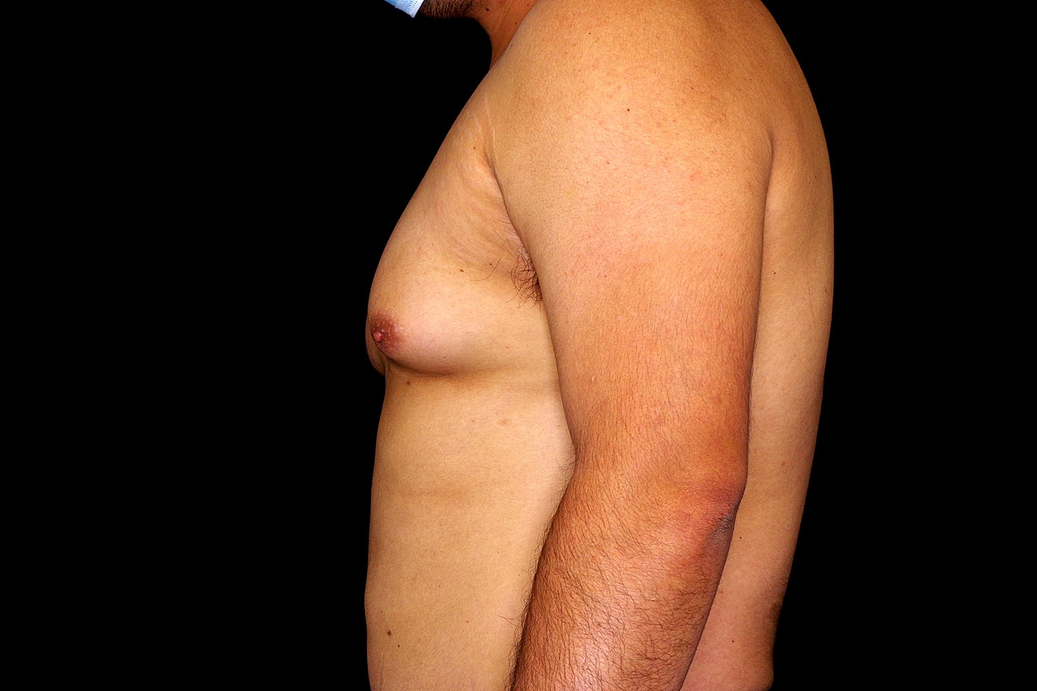 Gynecomastia Before & After