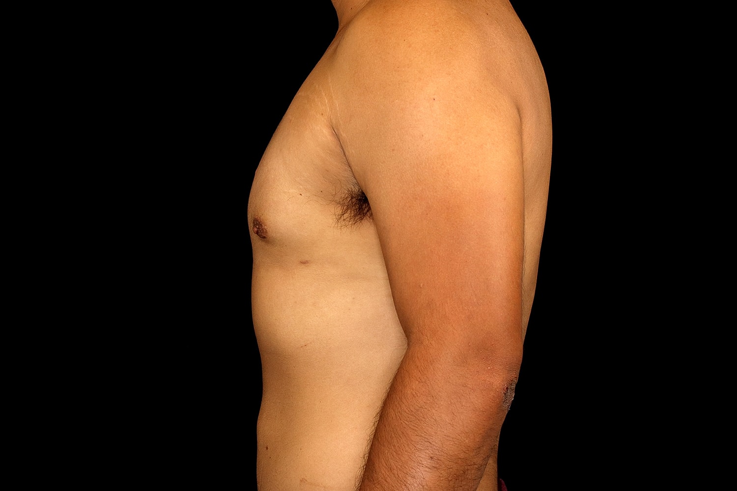 Gynecomastia Before & After