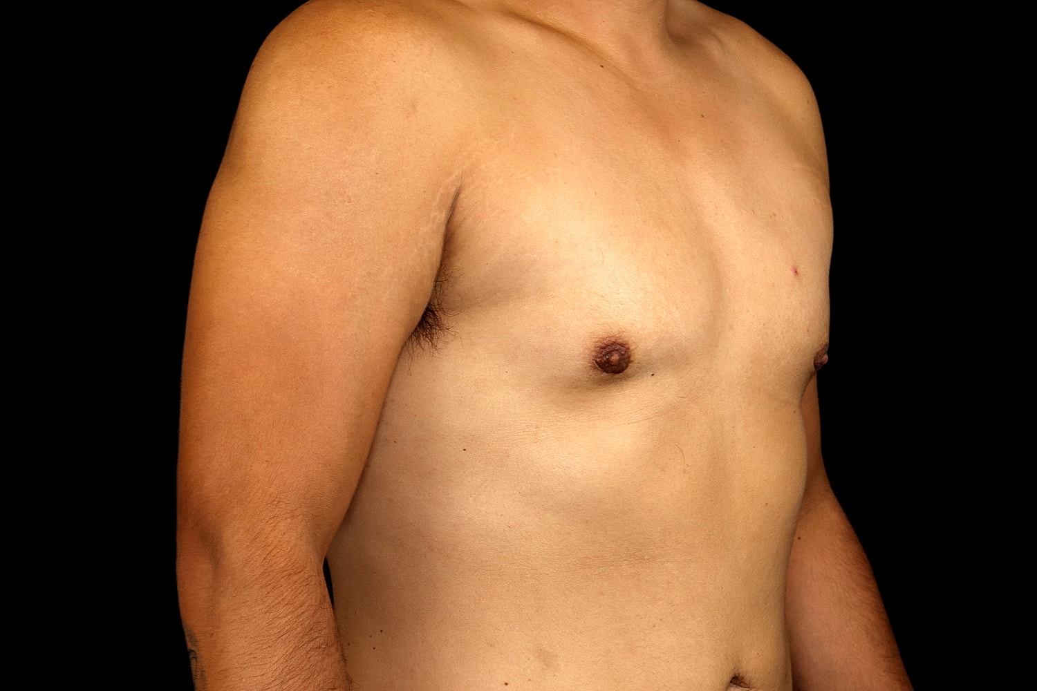Gynecomastia Before & After