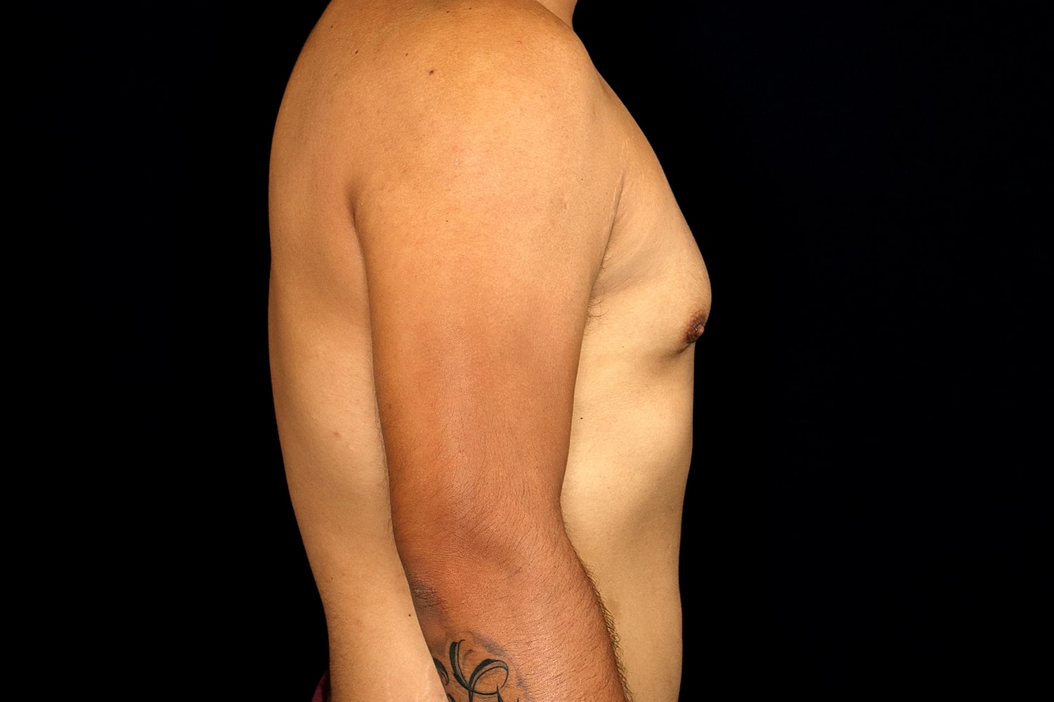 Gynecomastia Before & After