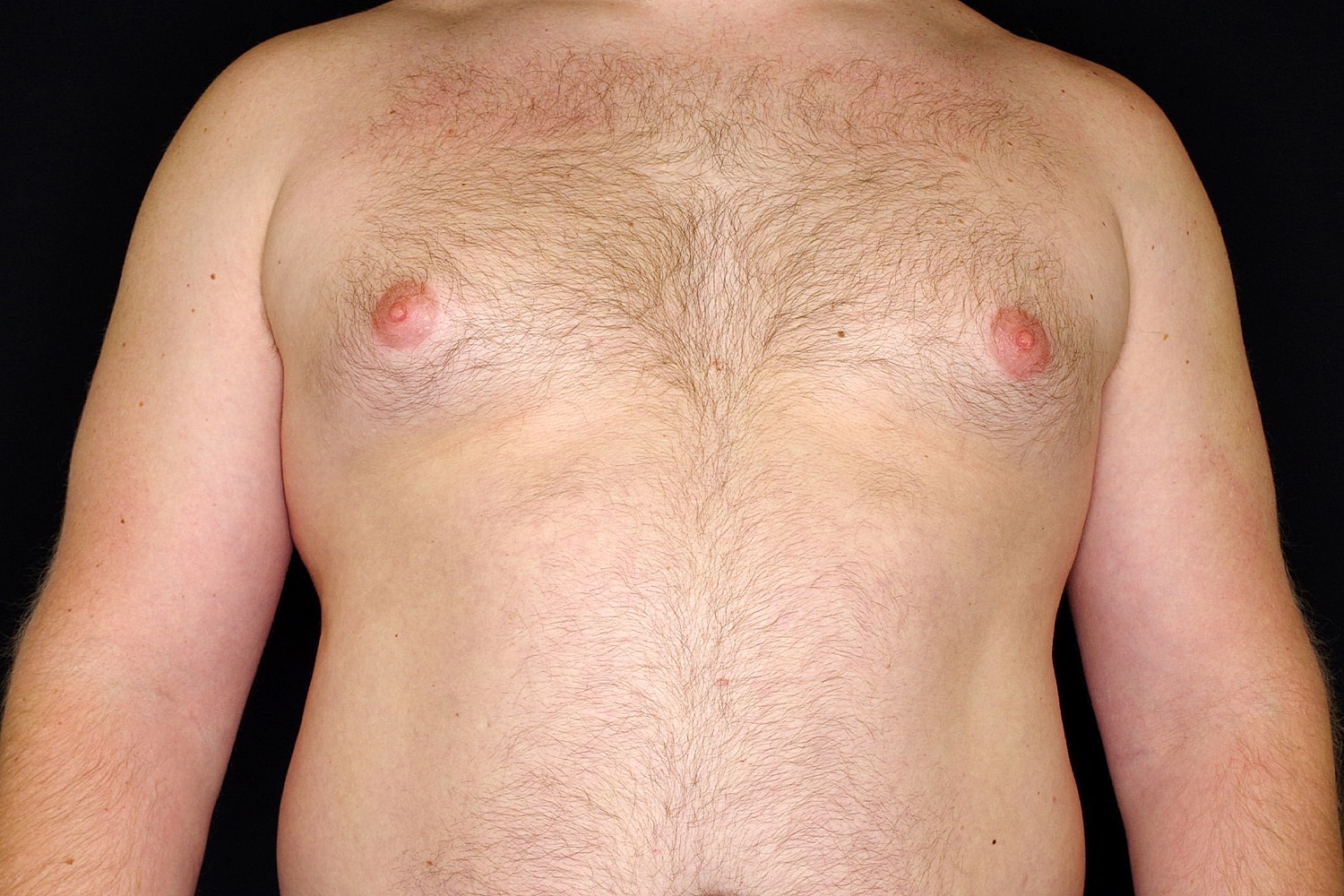 Gynecomastia Before & After