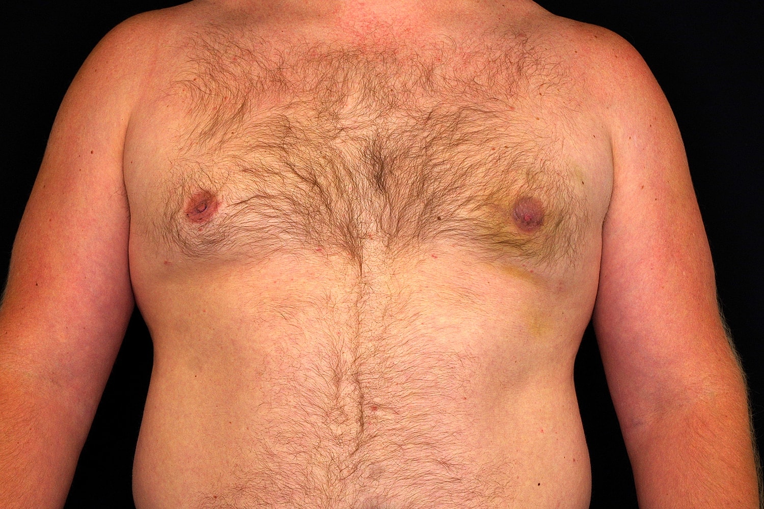 Gynecomastia Before & After