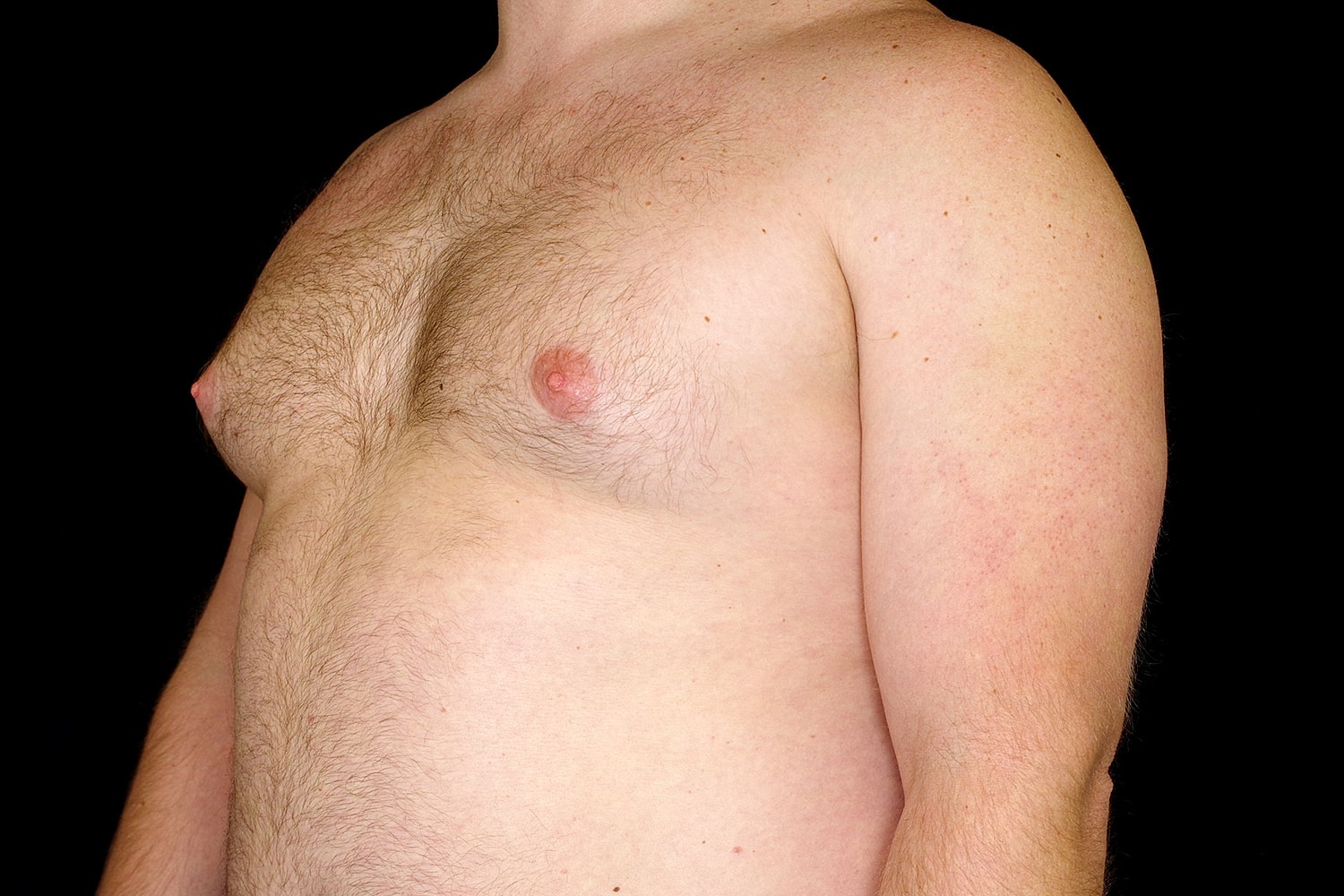 Gynecomastia Before & After