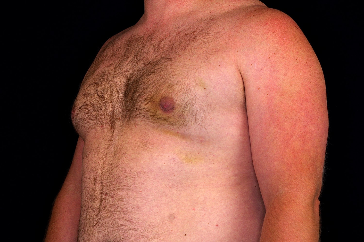 Gynecomastia Before & After