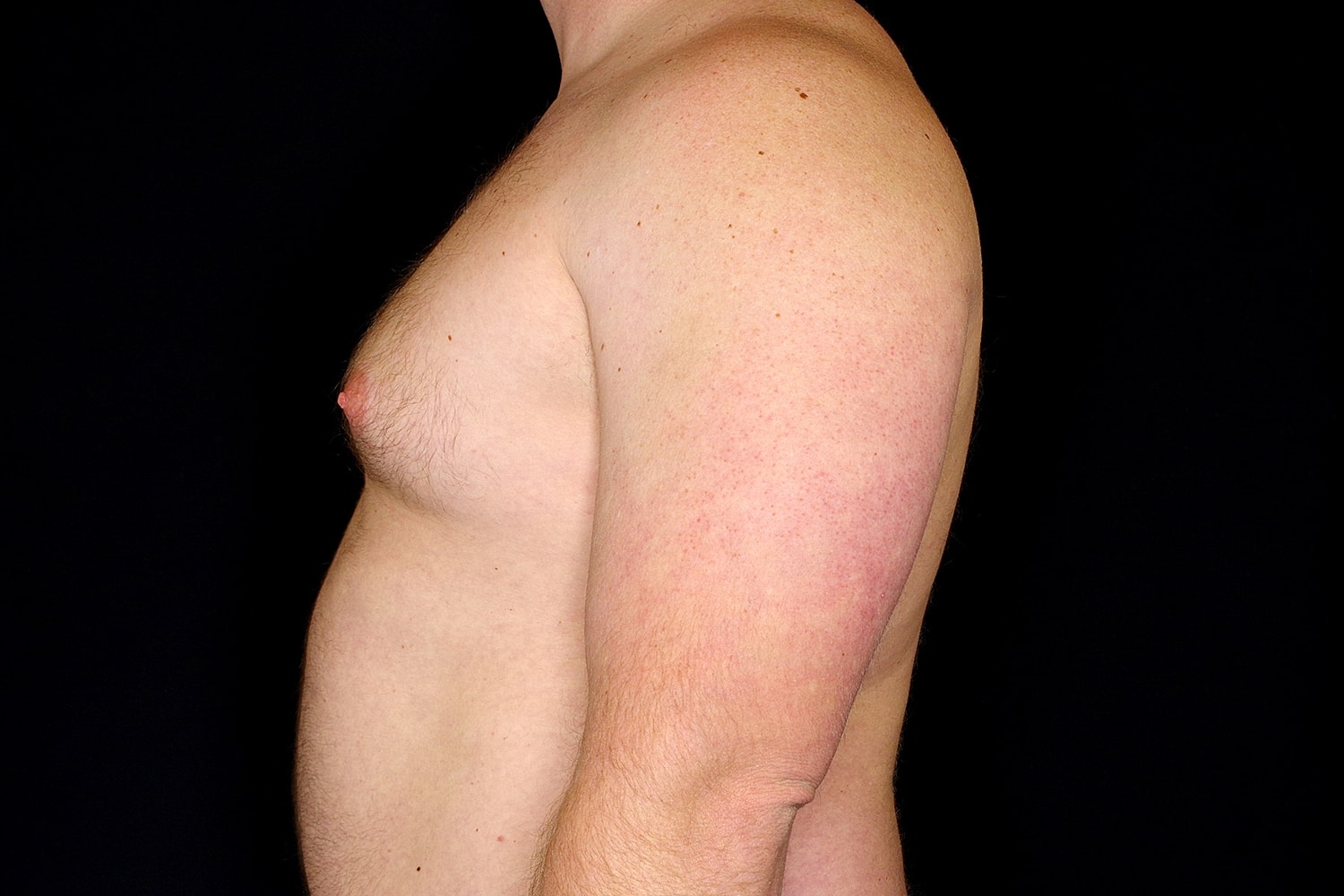 Gynecomastia Before & After