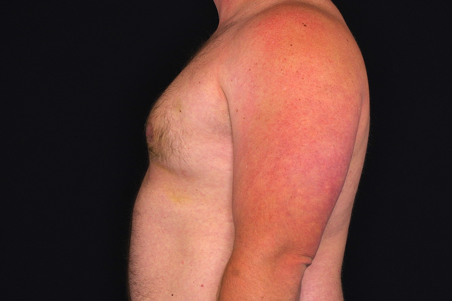 Gynecomastia Before & After
