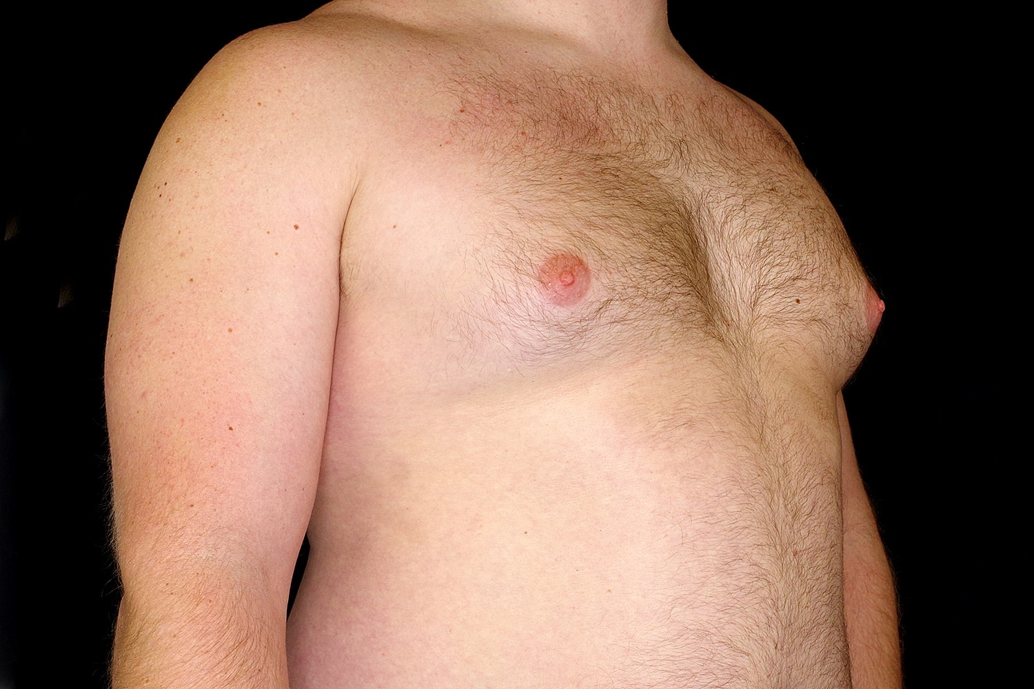 Gynecomastia Before & After