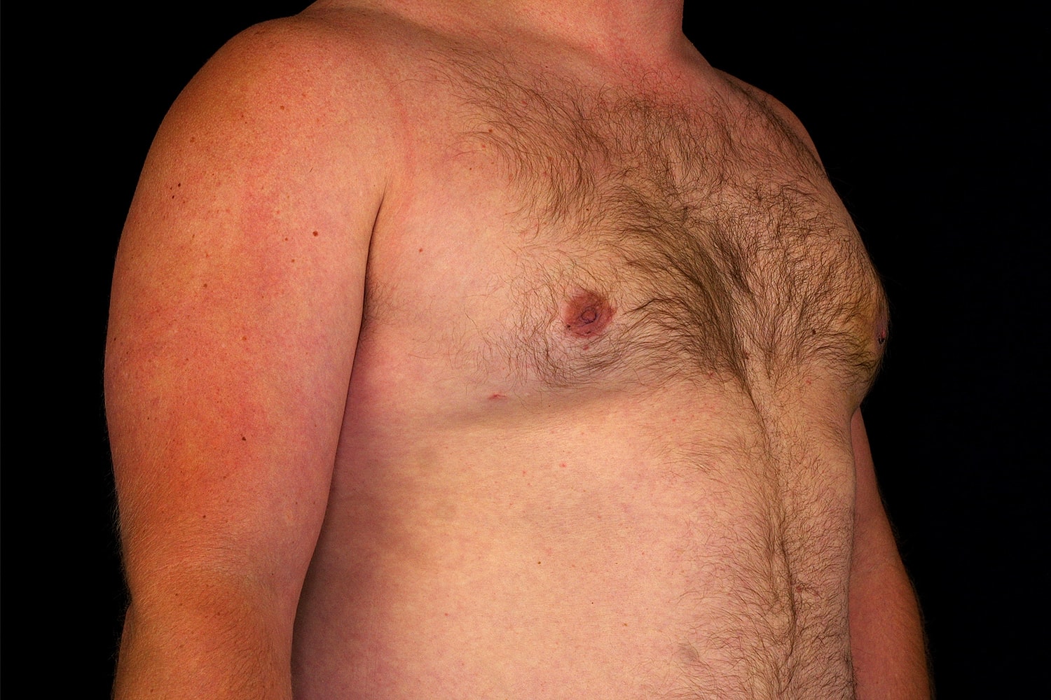 Gynecomastia Before & After