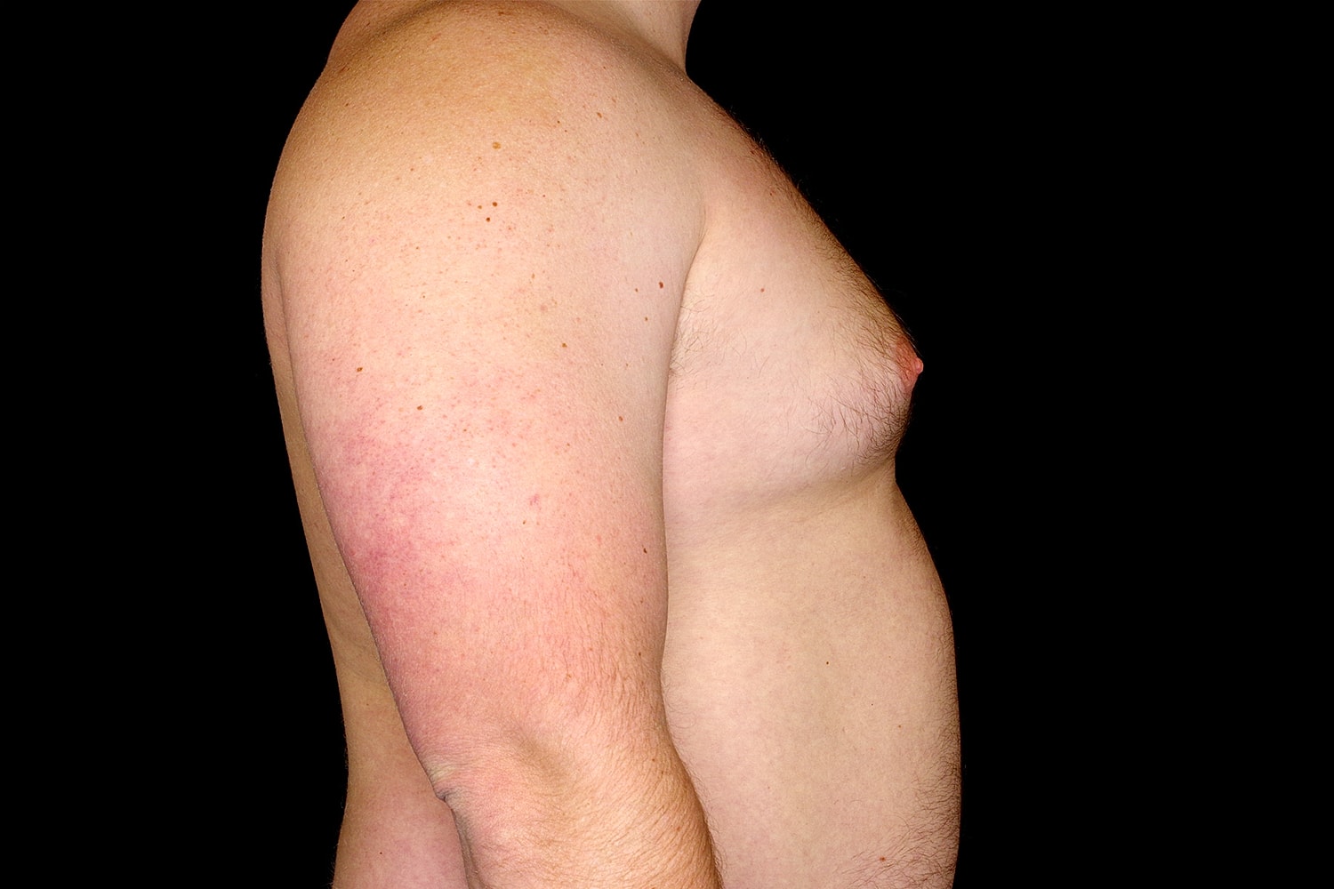 Gynecomastia Before & After