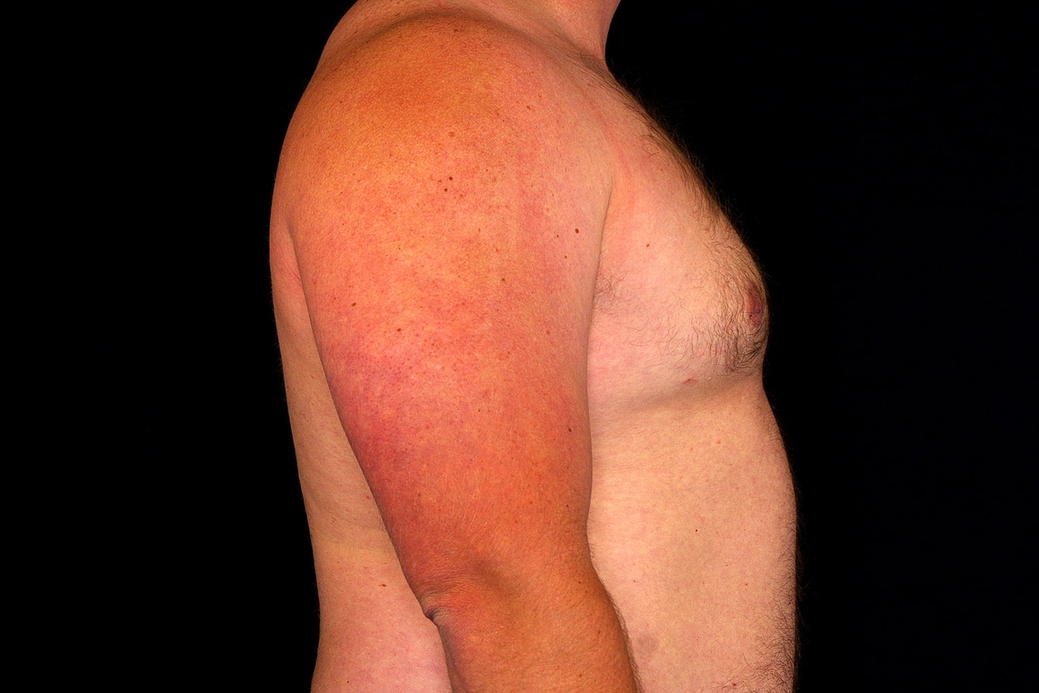 Gynecomastia Before & After