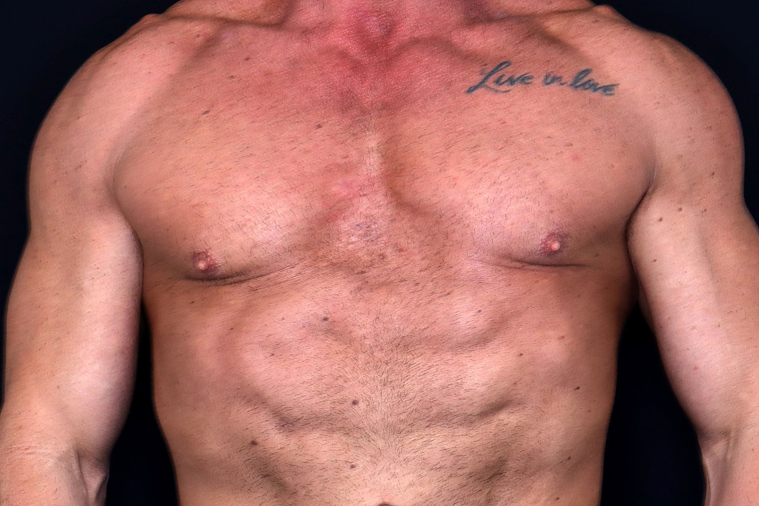 Gynecomastia Before & After