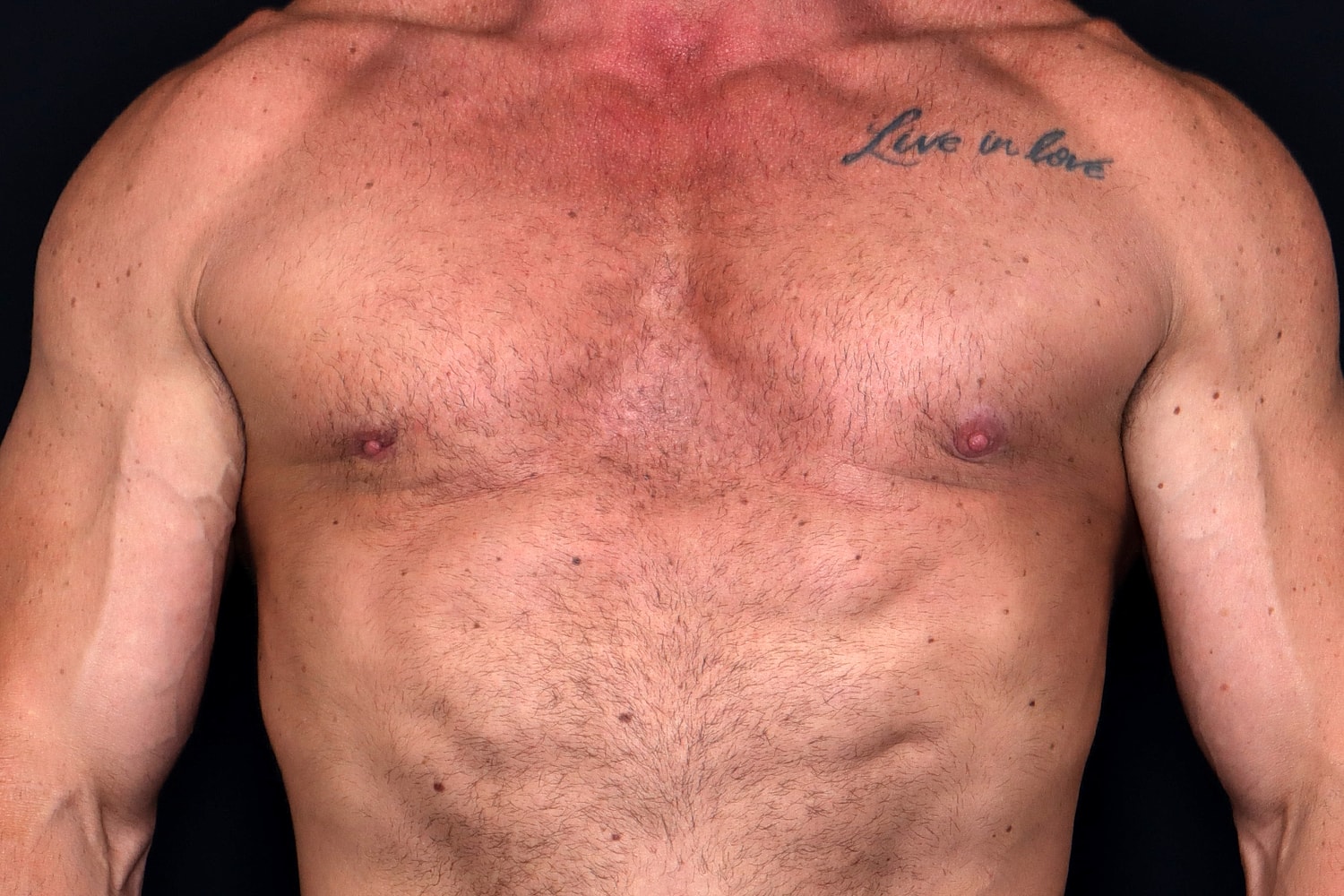 Gynecomastia Before & After