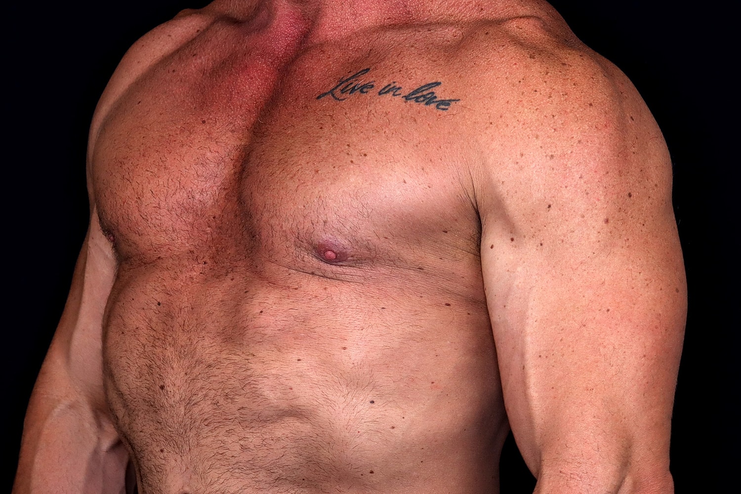 Gynecomastia Before & After
