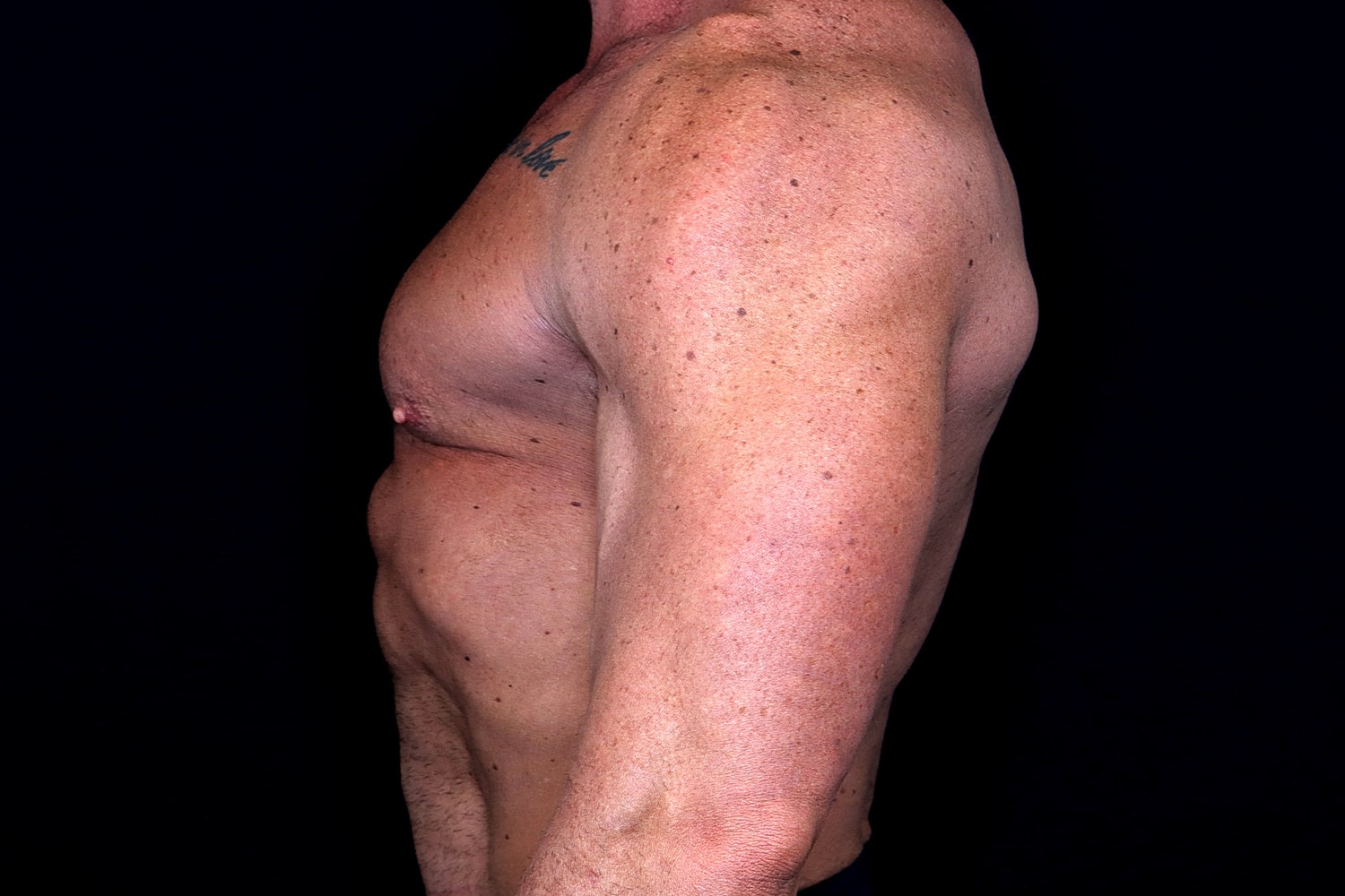 Gynecomastia Before & After