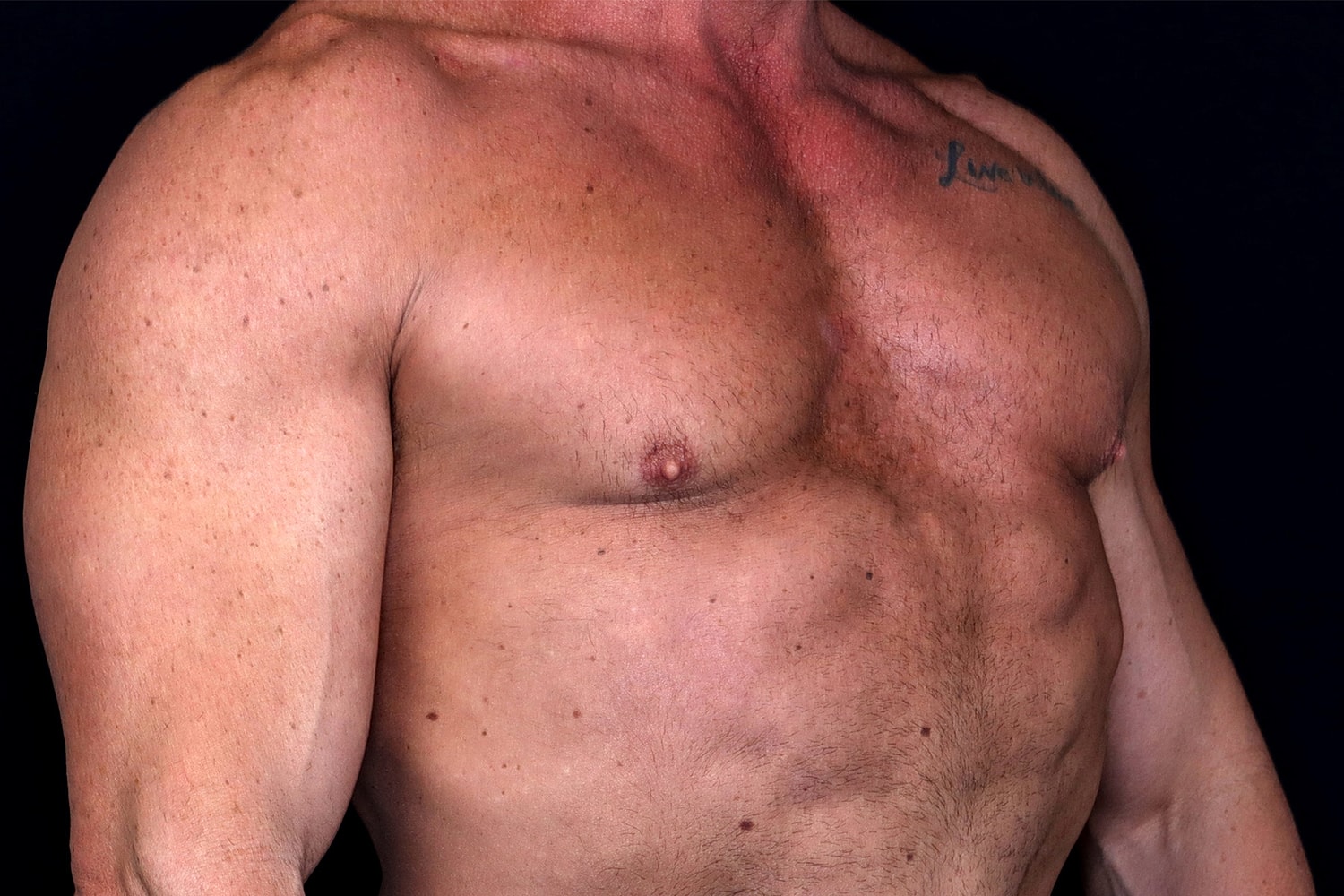 Gynecomastia Before & After