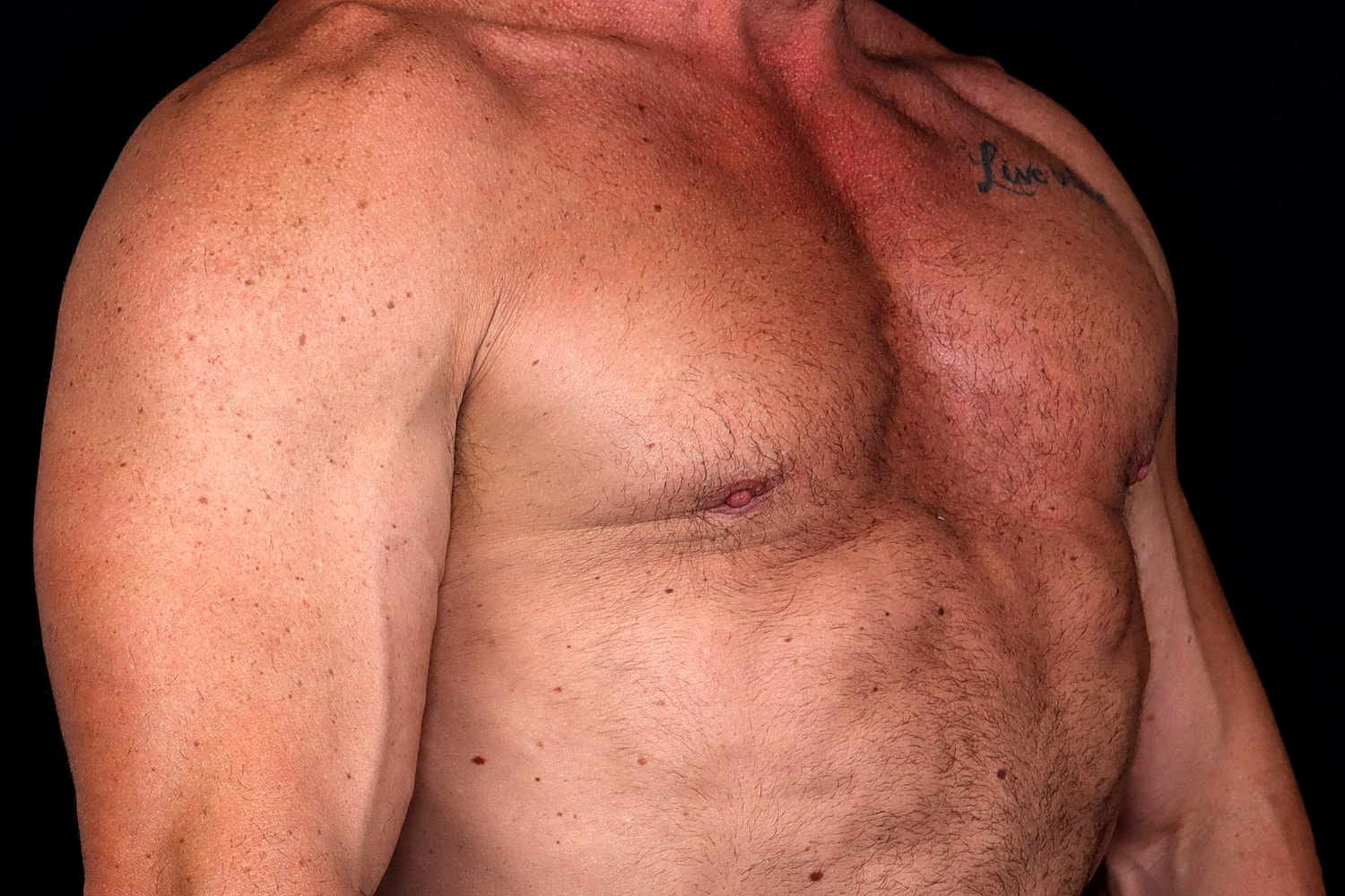 Gynecomastia Before & After