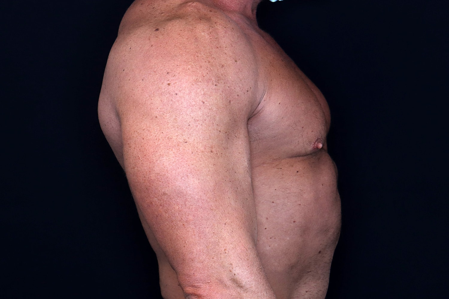 Gynecomastia Before & After