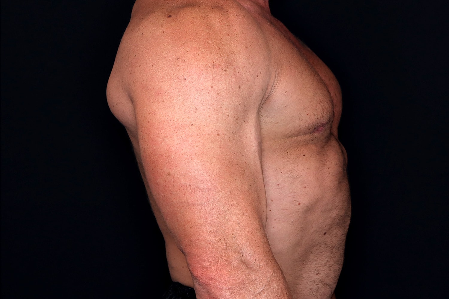 Gynecomastia Before & After