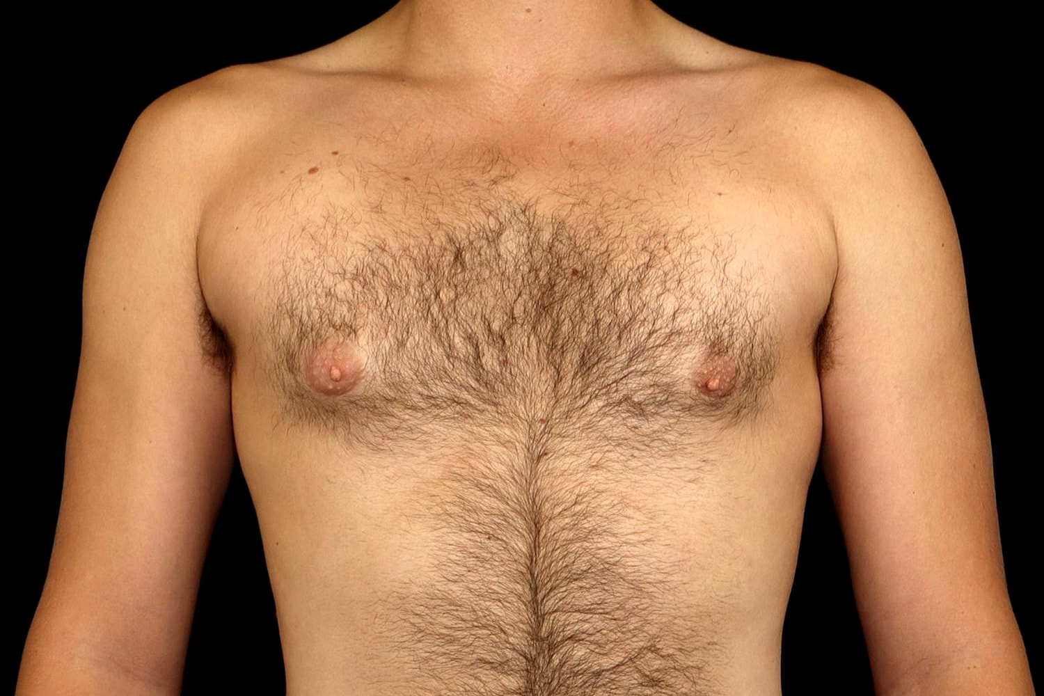 Gynecomastia Before & After