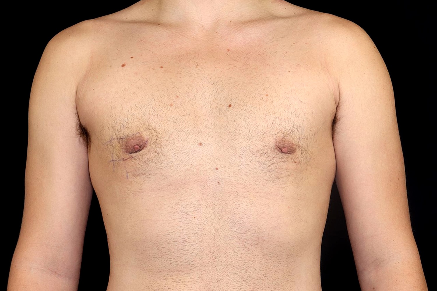Gynecomastia Before & After