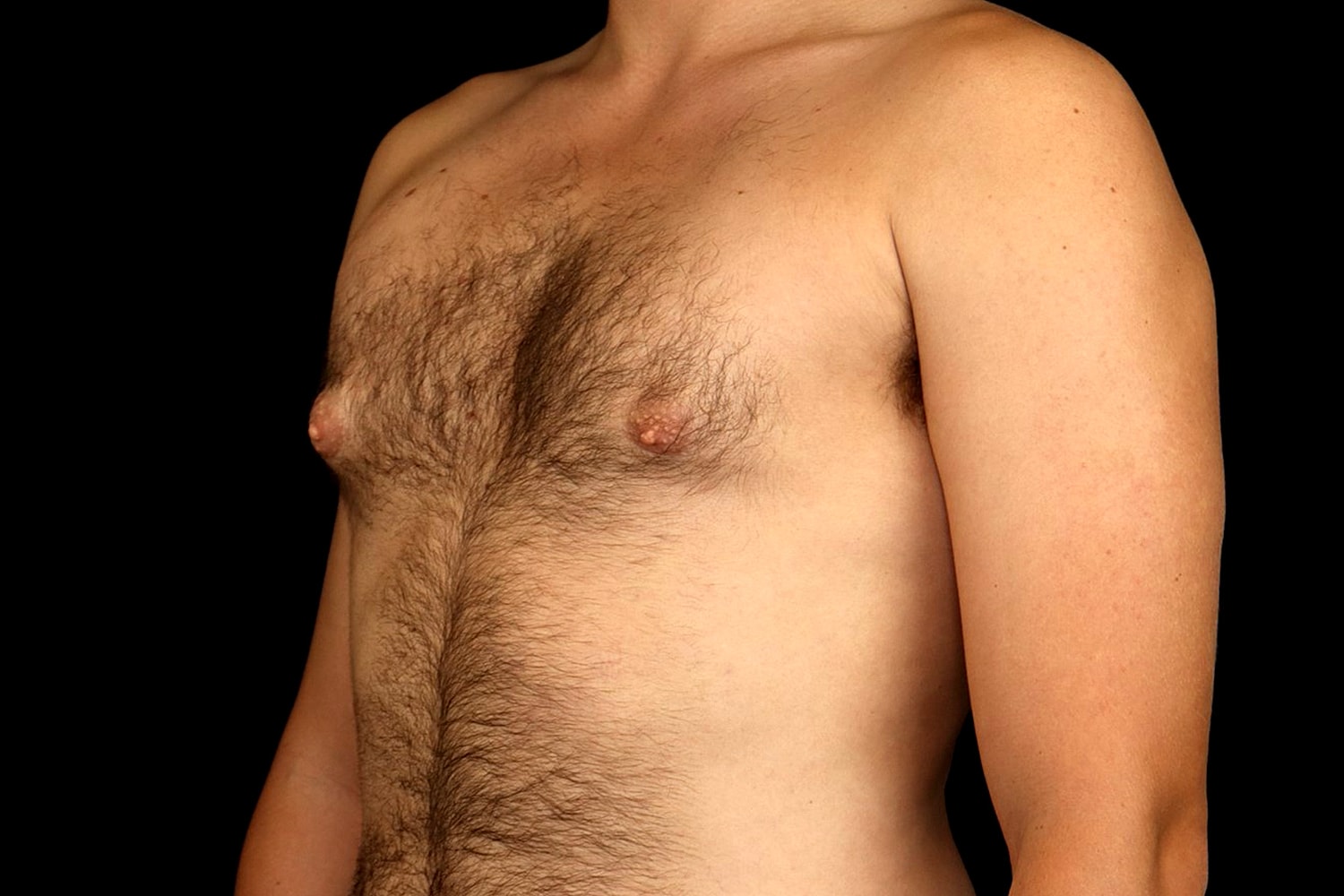 Gynecomastia Before & After