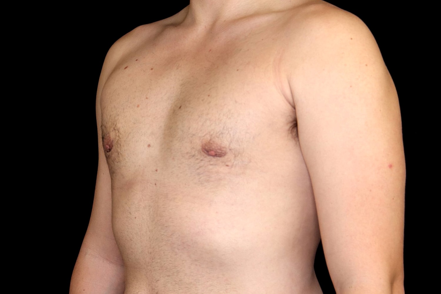Gynecomastia Before & After