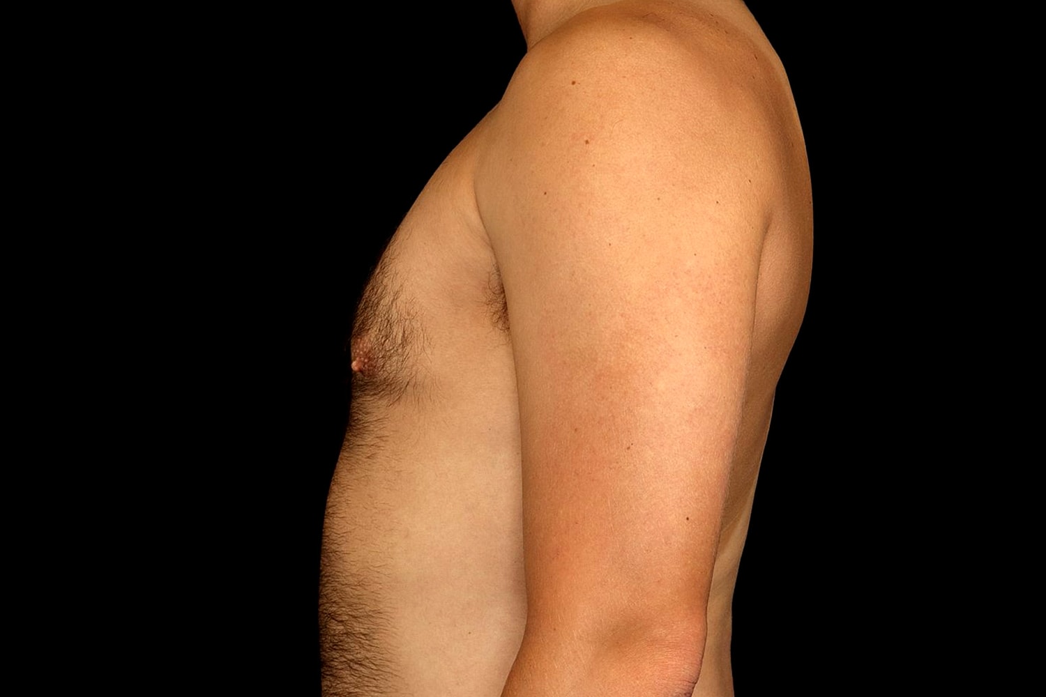 Gynecomastia Before & After