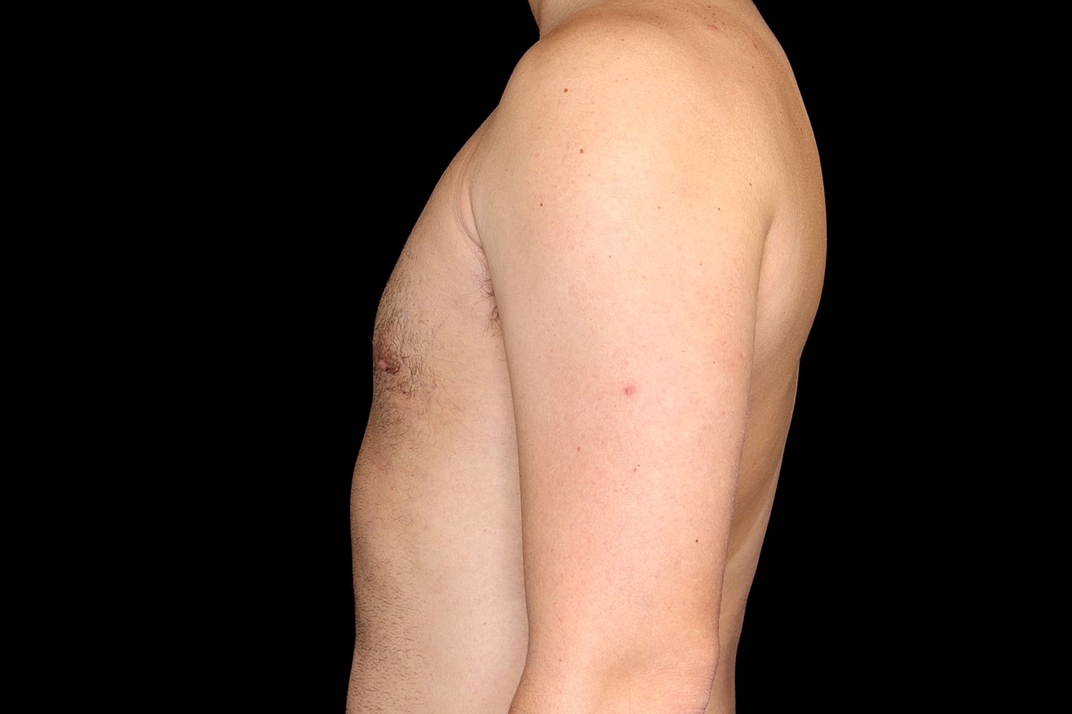 Gynecomastia Before & After