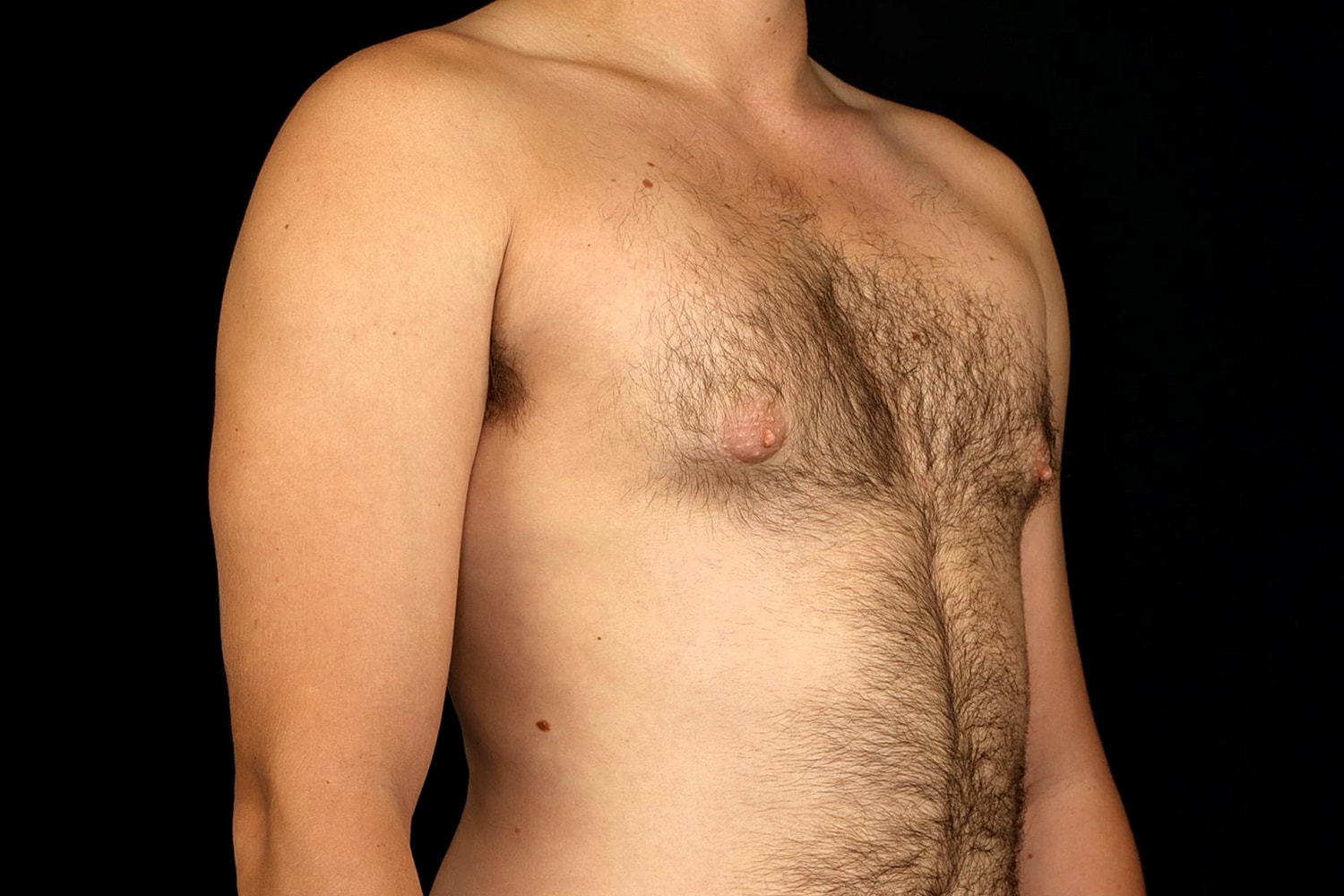 Gynecomastia Before & After