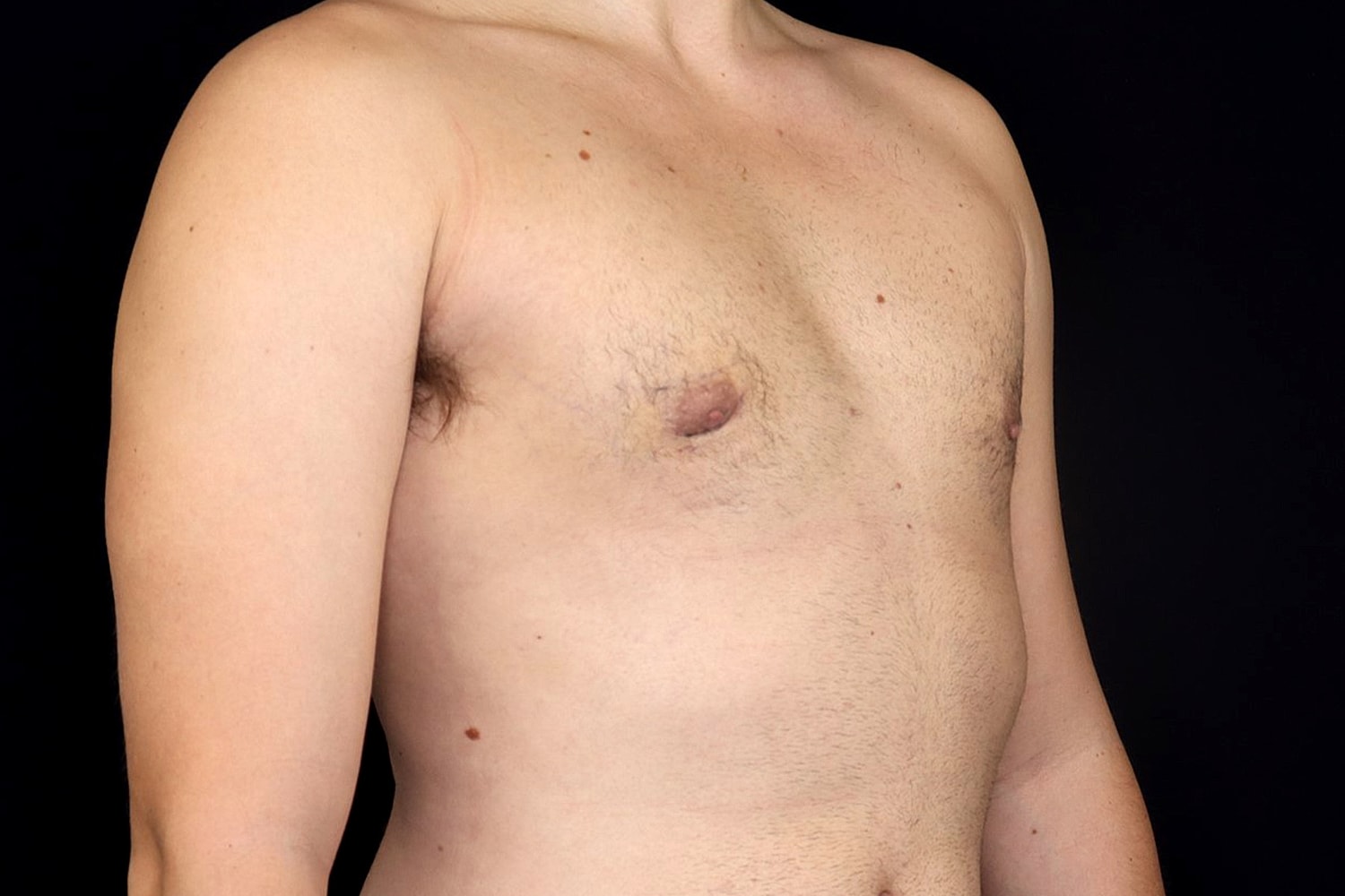 Gynecomastia Before & After