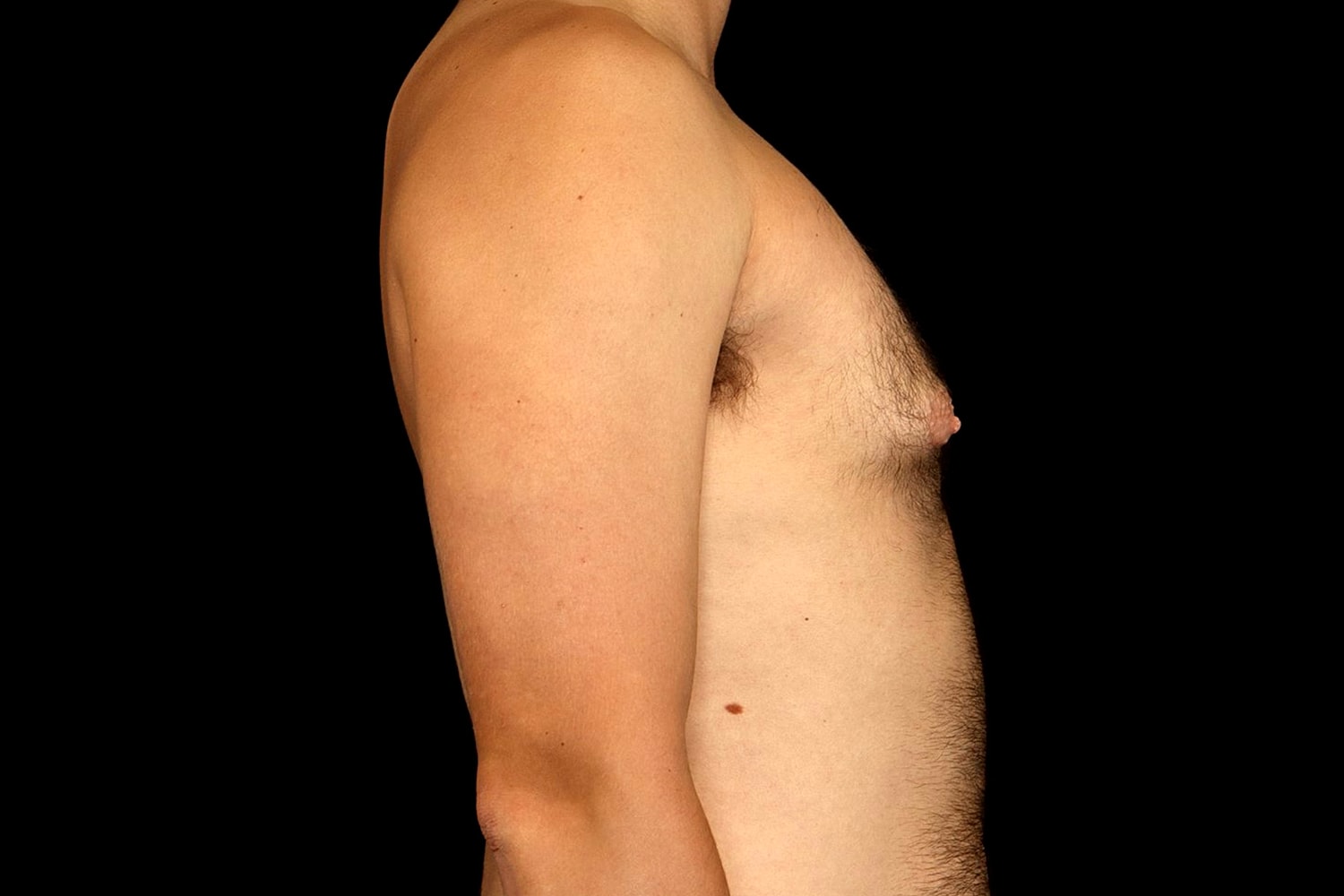 Gynecomastia Before & After