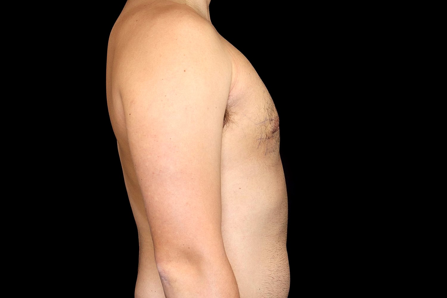 Gynecomastia Before & After