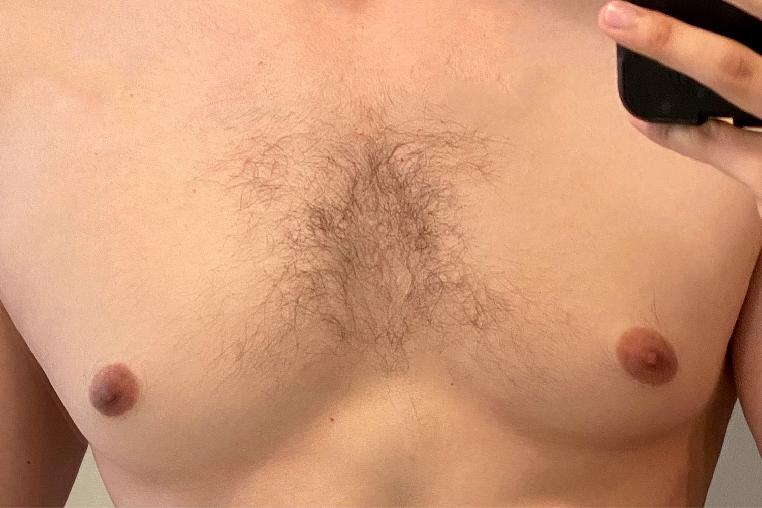 Gynecomastia Before & After