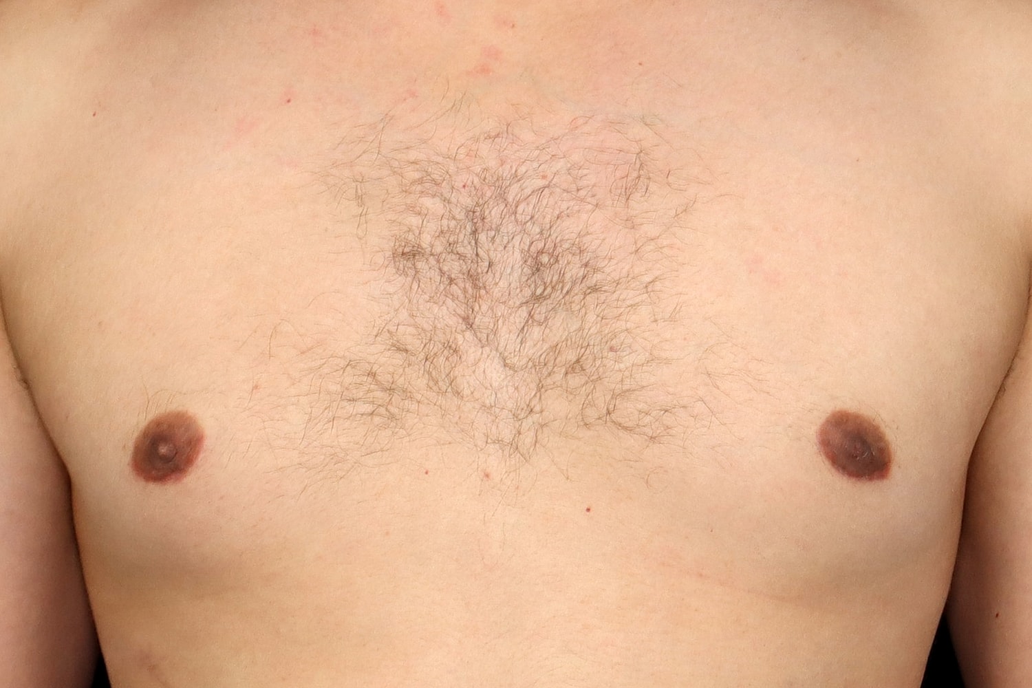 Gynecomastia Before & After