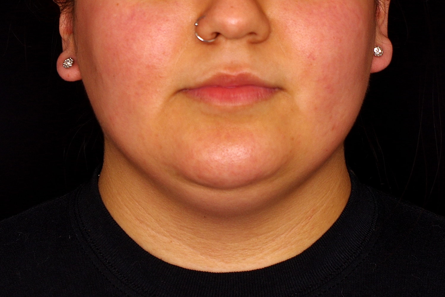Chin Liposuction Before & After