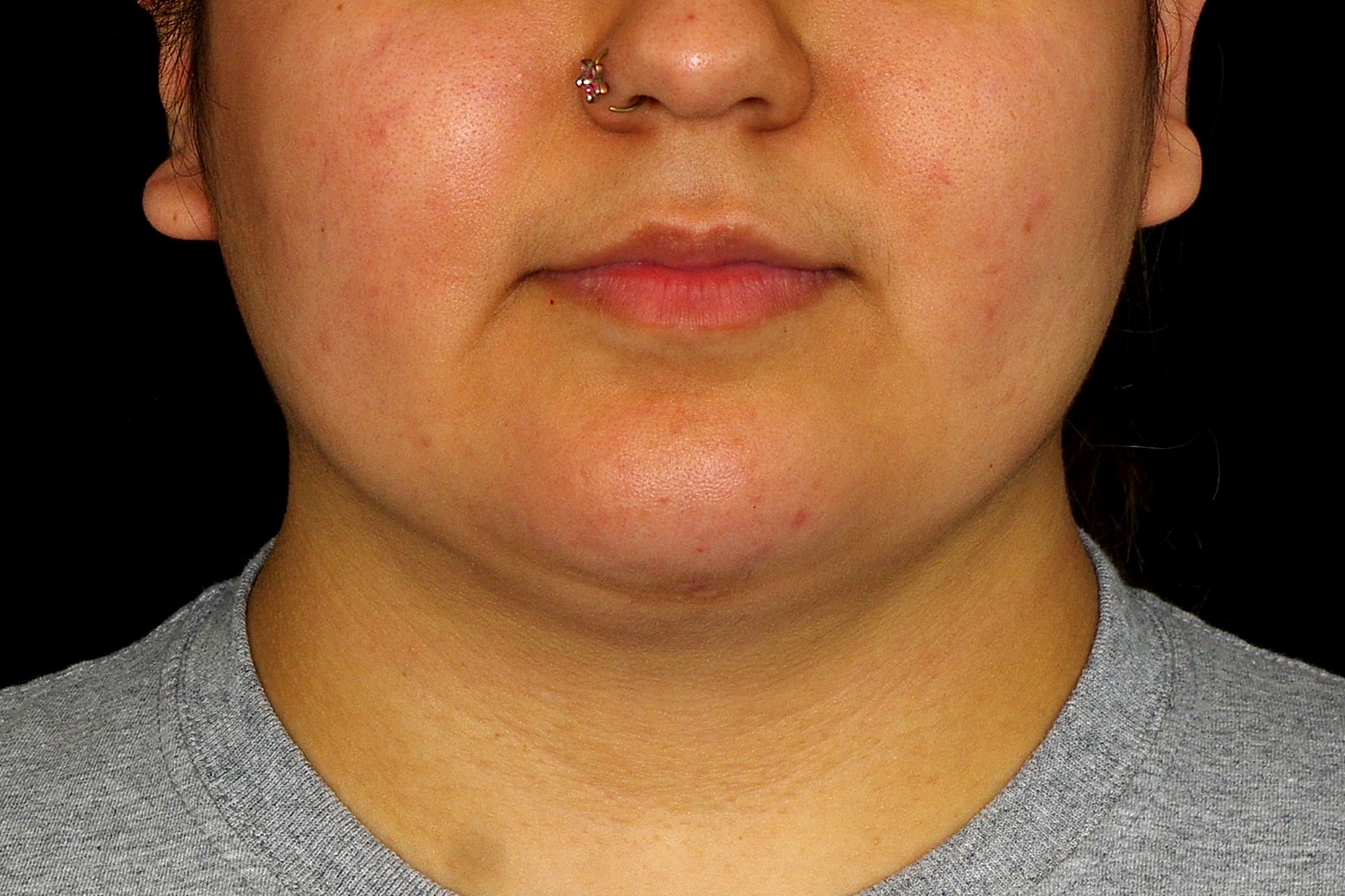 Chin Liposuction Before & After