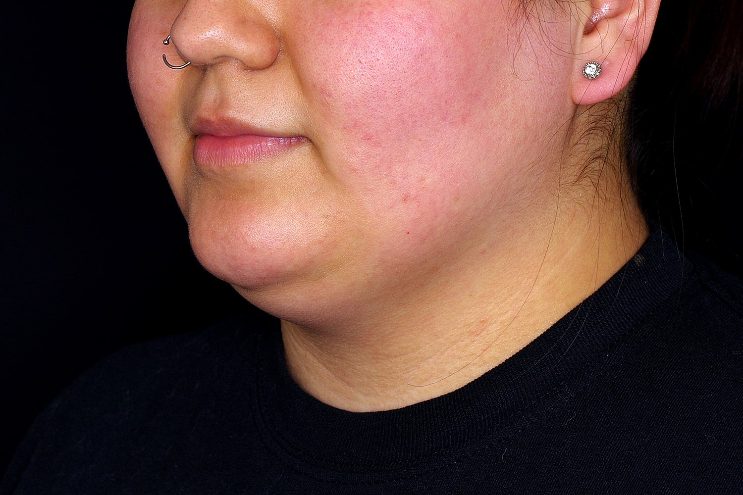 Chin Liposuction Before & After