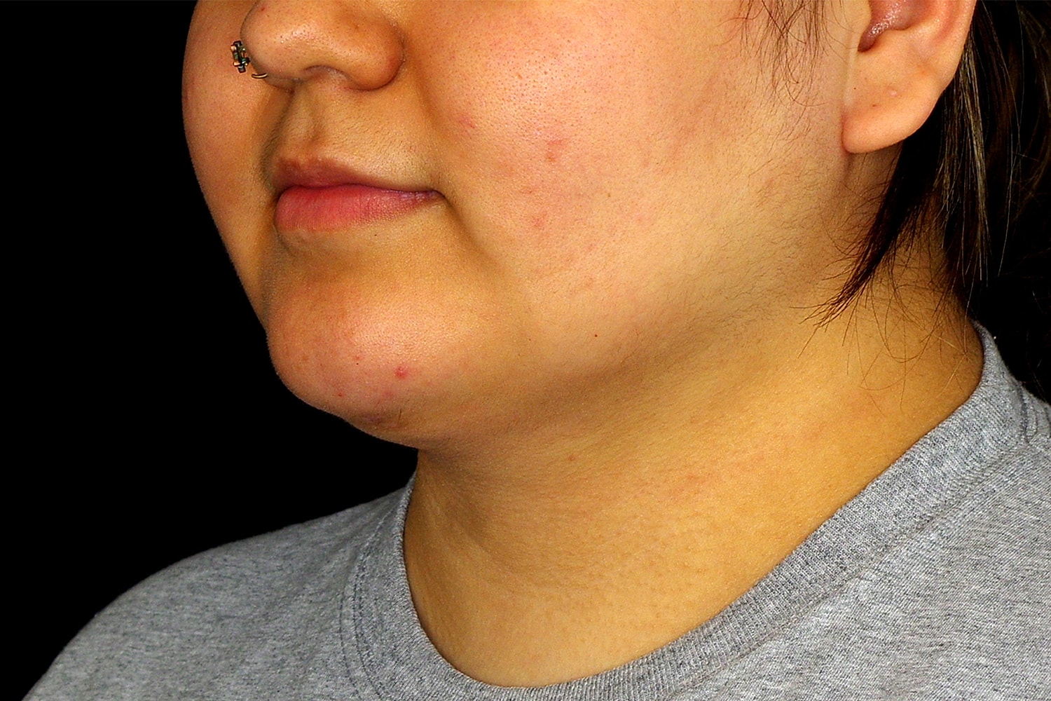 Chin Liposuction Before & After