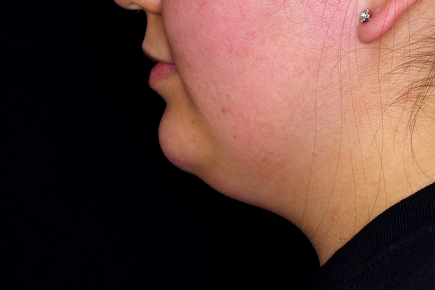 Chin Liposuction Before & After