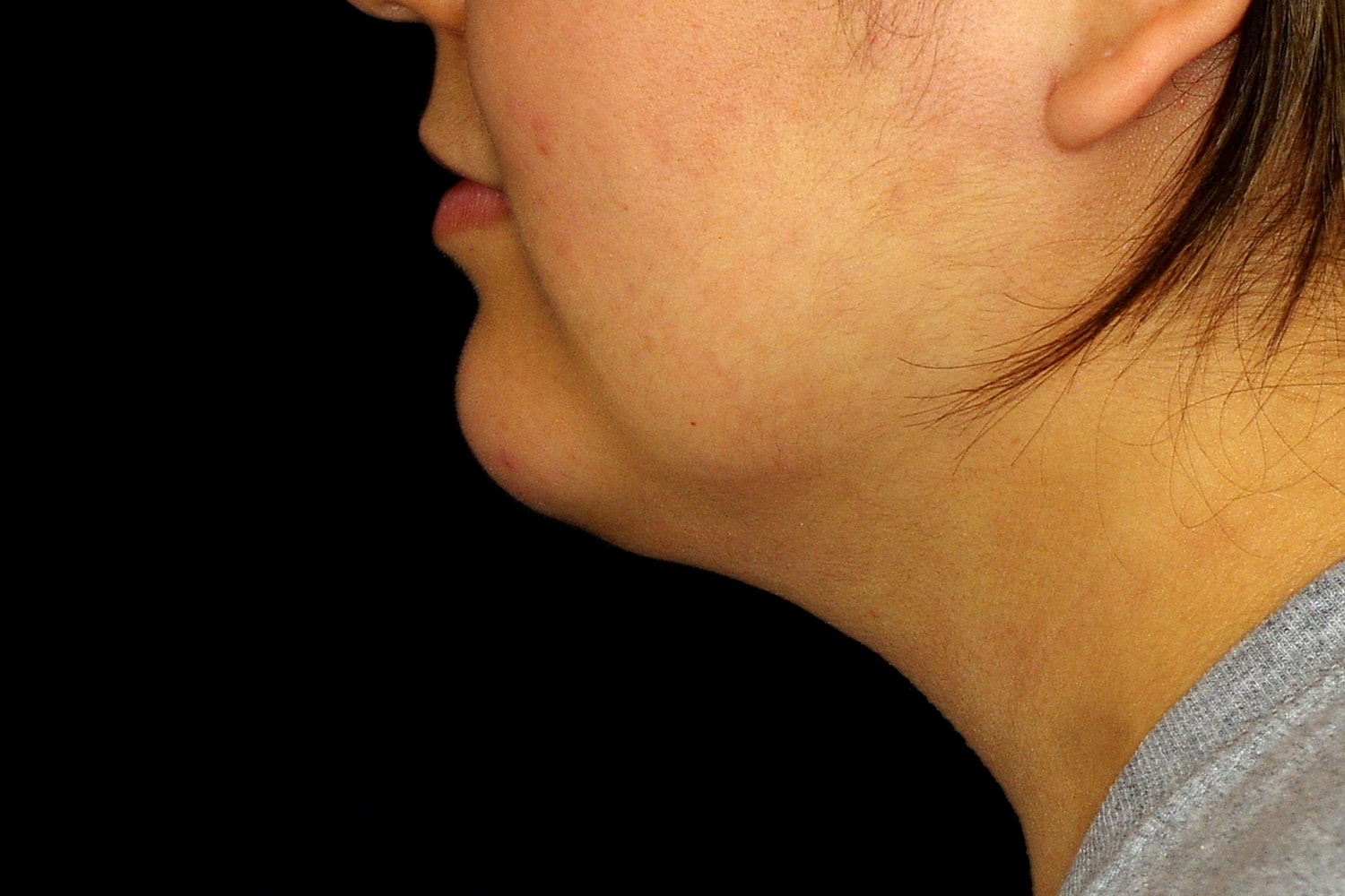 Chin Liposuction Before & After