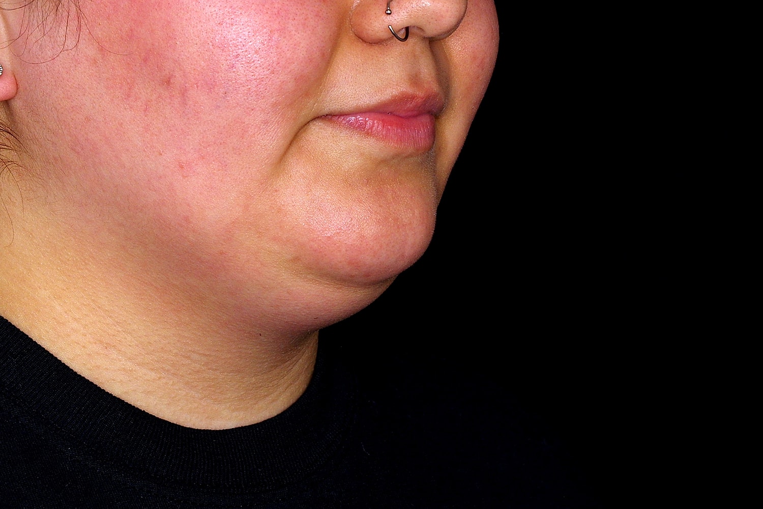 Chin Liposuction Before & After