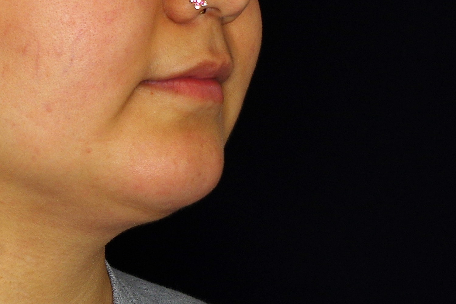 Chin Liposuction Before & After