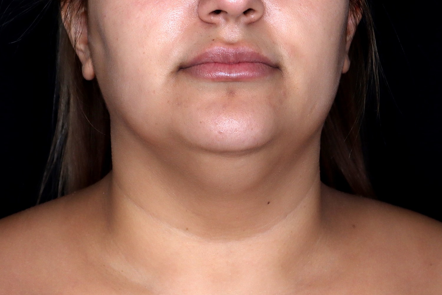 Chin Liposuction Before & After