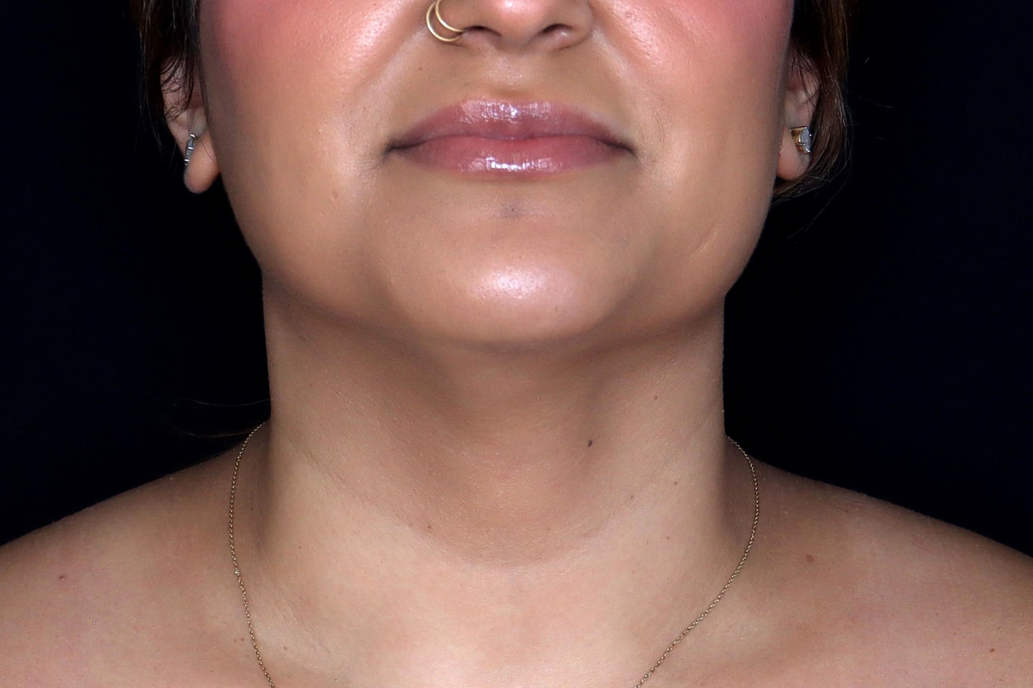 Chin Liposuction Before & After