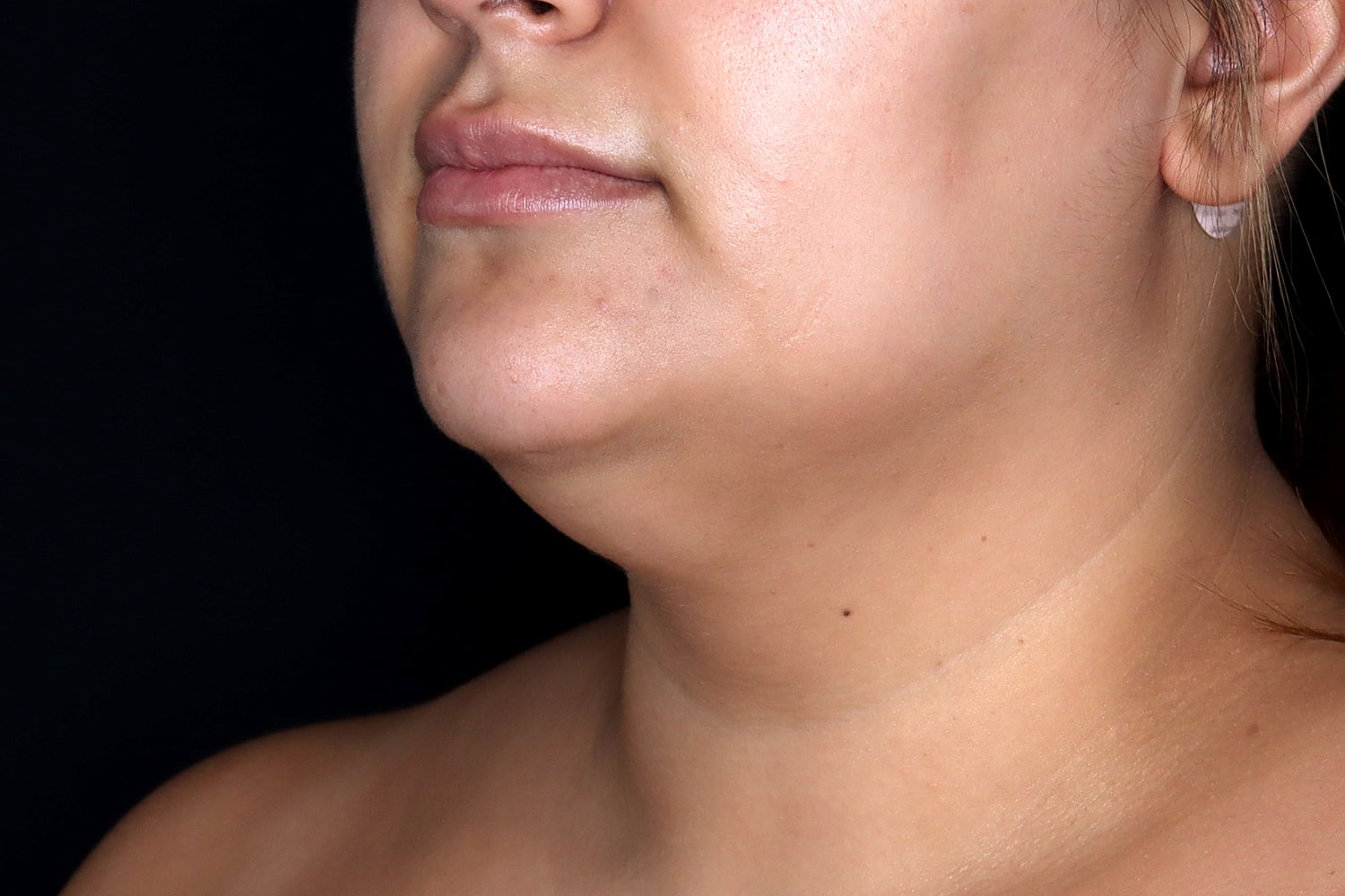Chin Liposuction Before & After