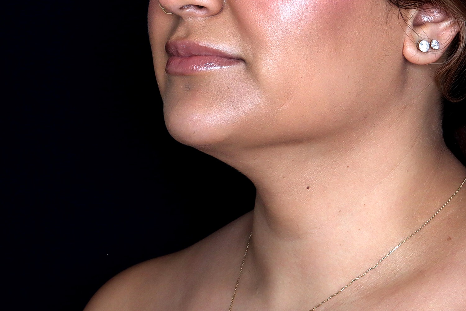 Chin Liposuction Before & After