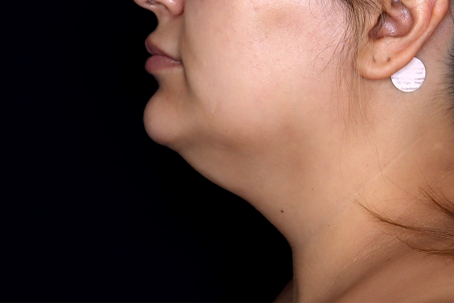 Chin Liposuction Before & After