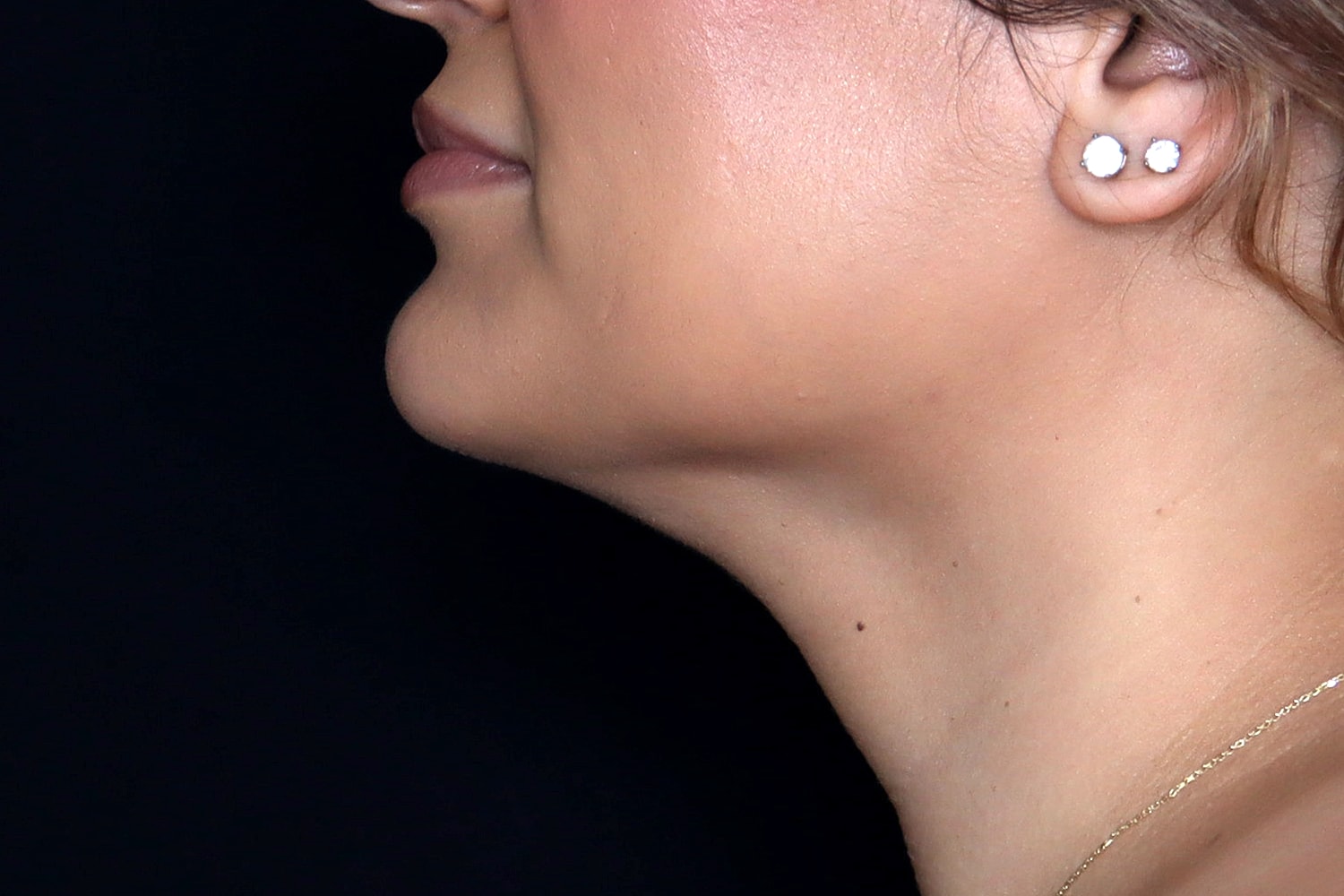 Chin Liposuction Before & After